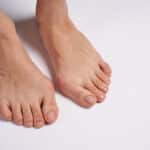 Toe Spacers for Bunions: A Non-Surgical Way to Ease Foot Pain