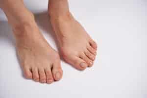 Toe spacers for bunions worn between the toes to relieve crowding and pressure